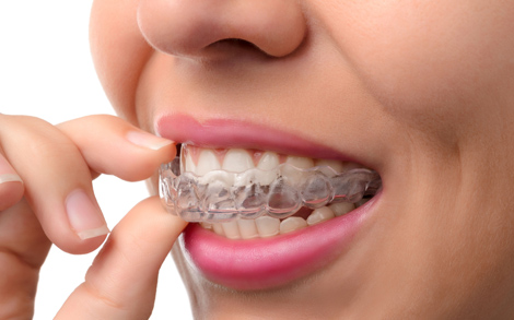 What Is Invisalign
