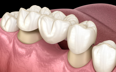 Who’s A Candidate For Dental Bridges