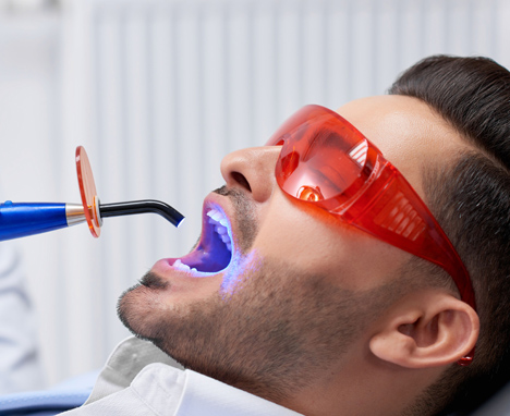 Why Are Dental Fillings A Necessity