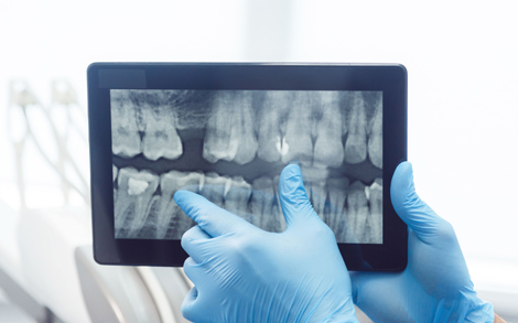 Why Are Dental X Rays So Important