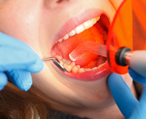 Why Is Dental Bonding Necessary